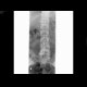 Fracture of vertebra L1: X-ray - Plain radiograph